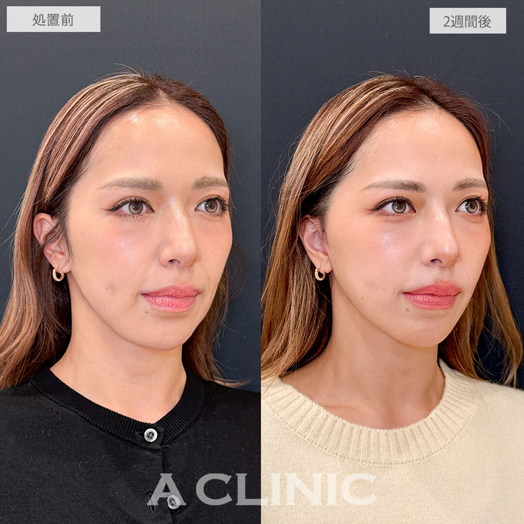 【直後の傷跡あり】A式美肌たるみ切開でほうれい線やたるみが劇的に改善！こちら処置前と2週間後の症例です(40代女性)