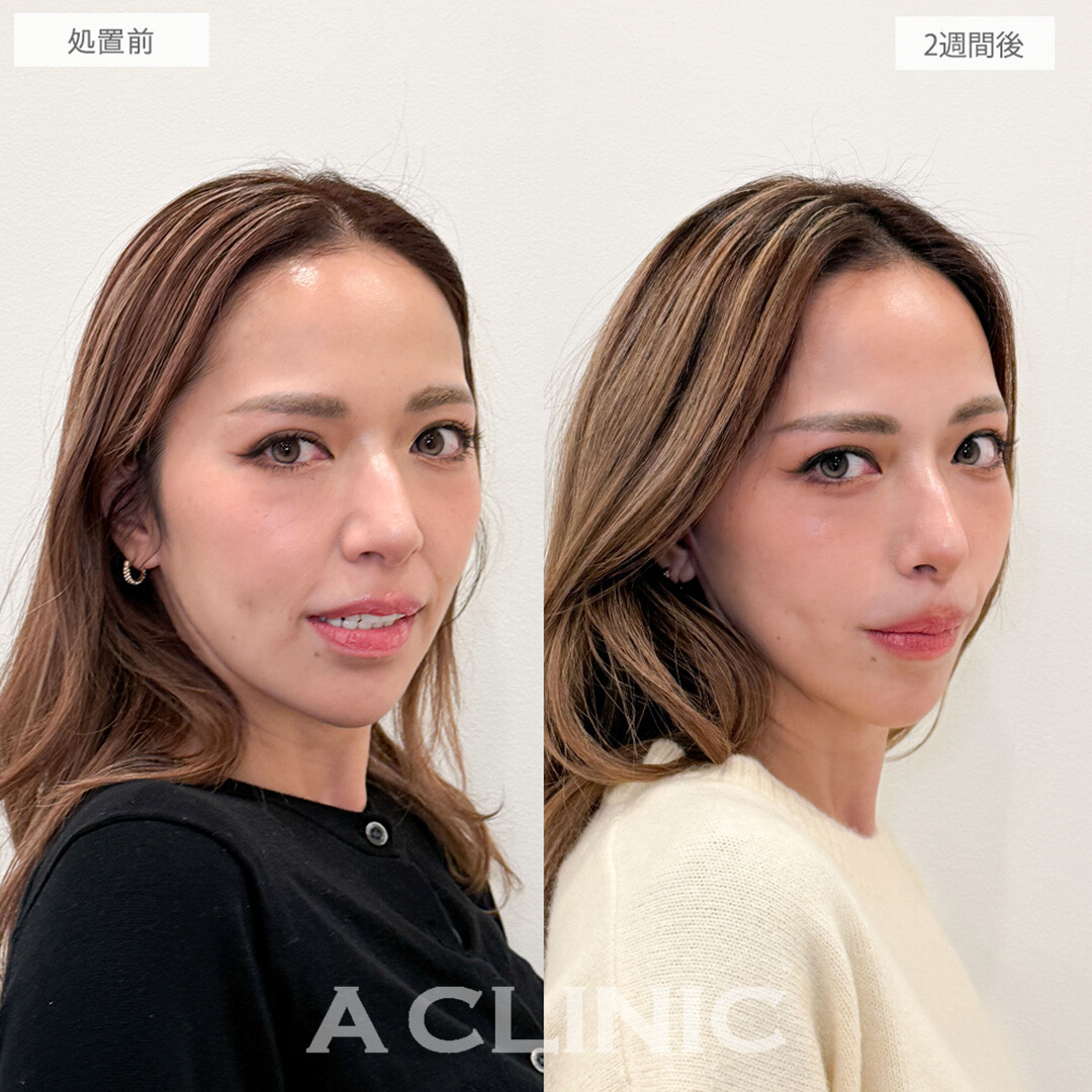 【直後の傷跡あり】A式美肌たるみ切開でほうれい線やたるみが劇的に改善！こちら処置前と2週間後の症例です(40代女性)