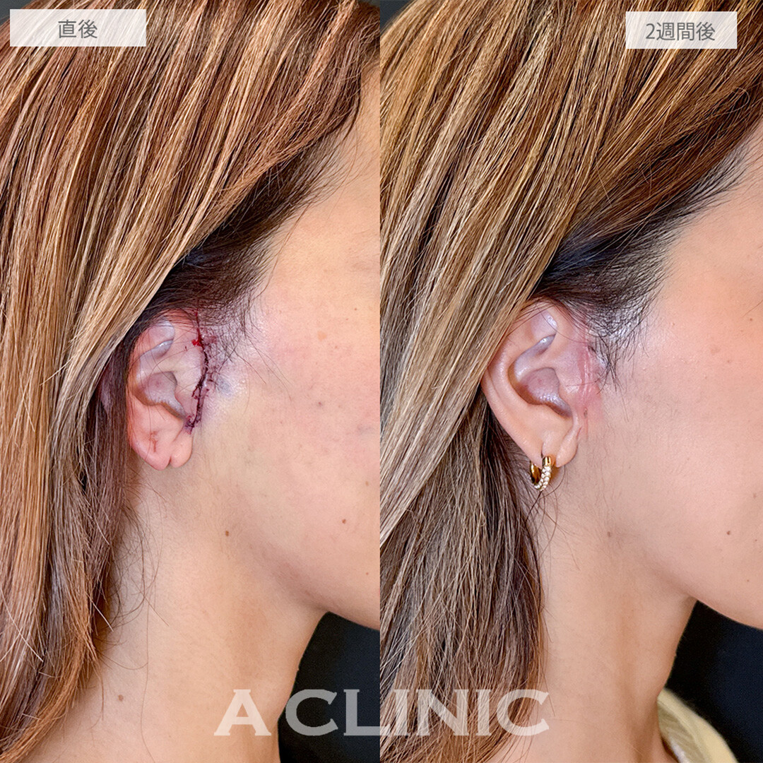 【直後の傷跡あり】A式美肌たるみ切開でほうれい線やたるみが劇的に改善！こちら処置前と2週間後の症例です(40代女性)