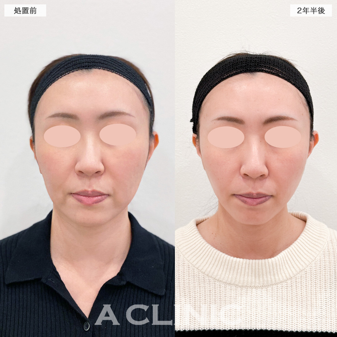 【直後の傷跡あり】A式美肌たるみ切開は長期経過しても輪郭の崩れが目立ちにくいです!こちら処置前と2年半後の症例です(30代女性)