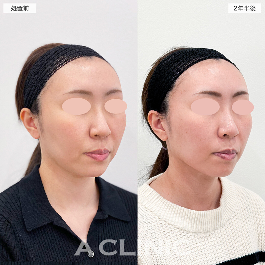 【直後の傷跡あり】A式美肌たるみ切開は長期経過しても輪郭の崩れが目立ちにくいです!こちら処置前と2年半後の症例です(30代女性)