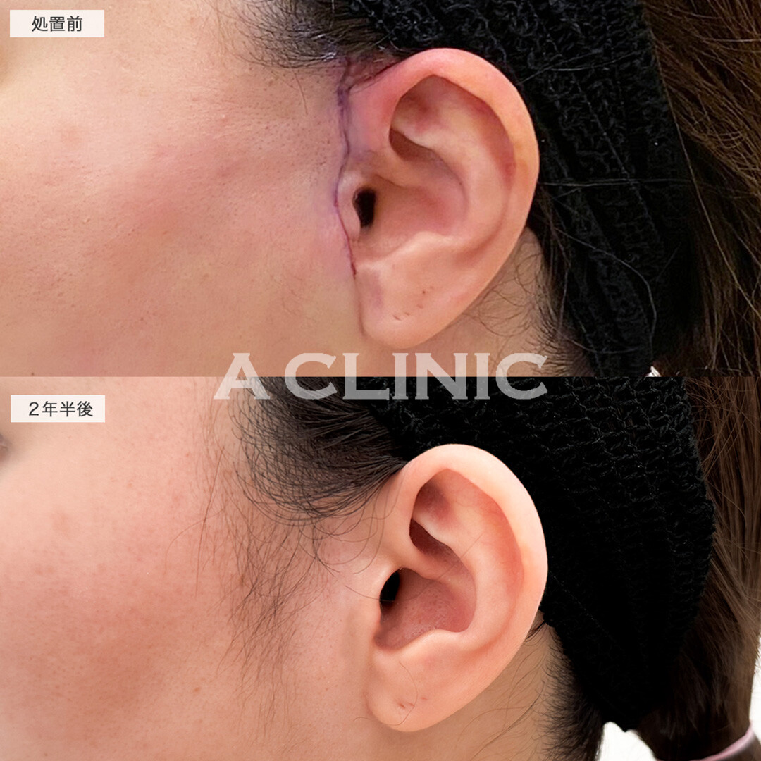 【直後の傷跡あり】A式美肌たるみ切開は長期経過しても輪郭の崩れが目立ちにくいです!こちら処置前と2年半後の症例です(30代女性)