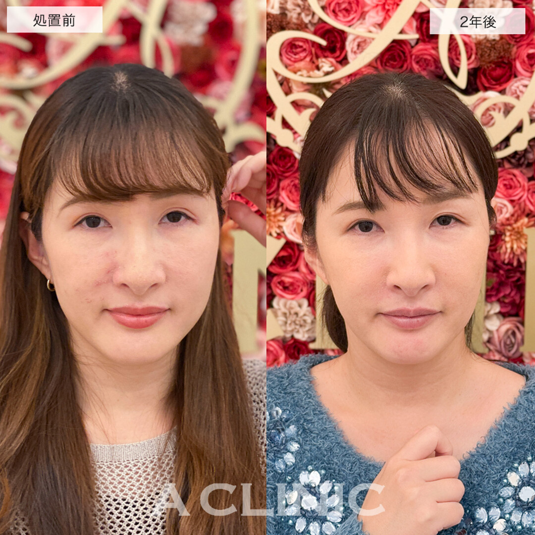 【直後の傷跡あり】A式美肌たるみ切開は2年後もたるみを感じない若々しい輪郭のままです!こちら処置前と2年後の症例です(30代女性)