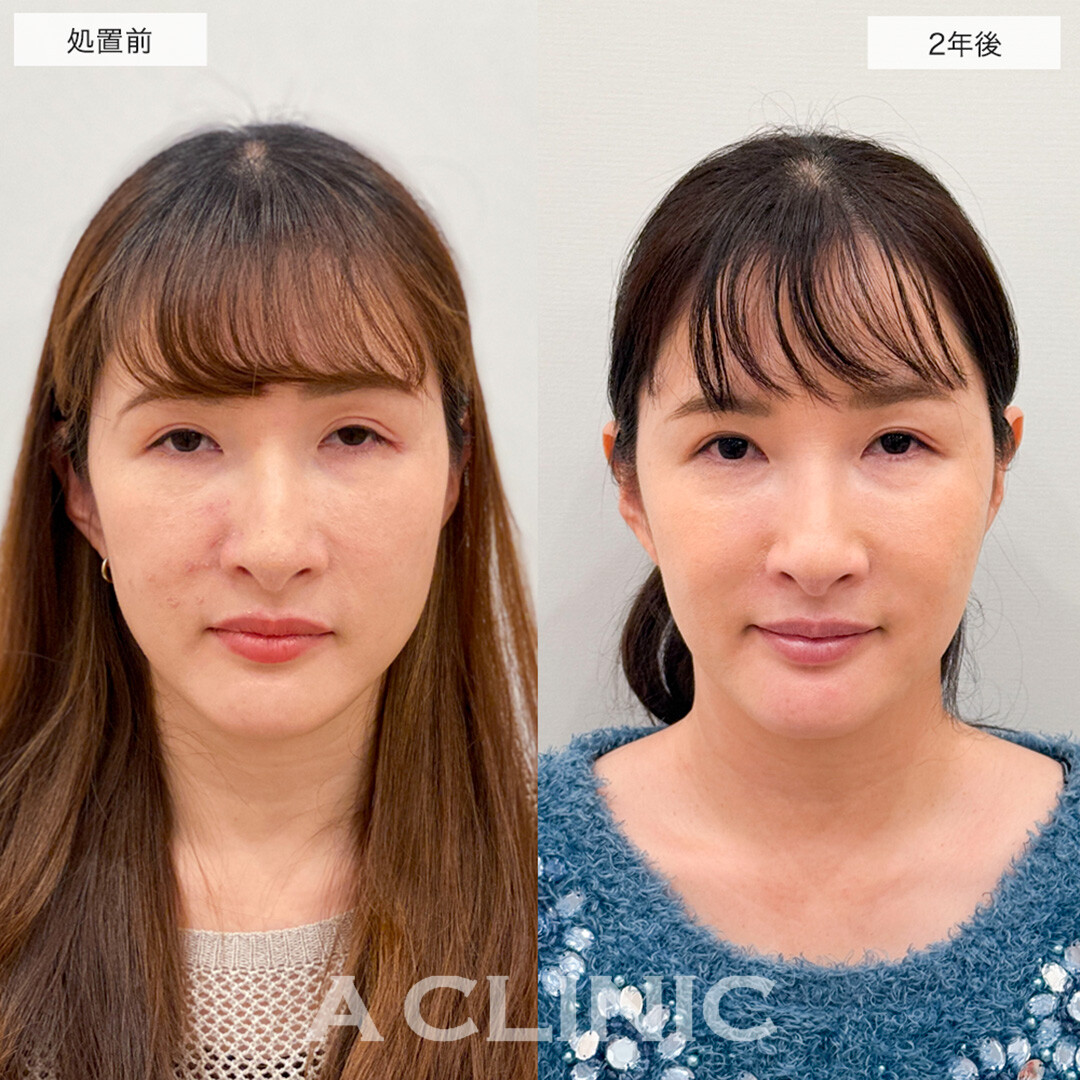 【直後の傷跡あり】A式美肌たるみ切開は2年後もたるみを感じない若々しい輪郭のままです!こちら処置前と2年後の症例です(30代女性)