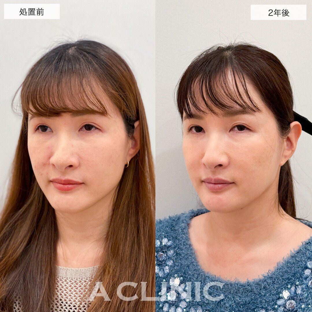 【直後の傷跡あり】A式美肌たるみ切開は2年後もたるみを感じない若々しい輪郭のままです!こちら処置前と2年後の症例です(30代女性)