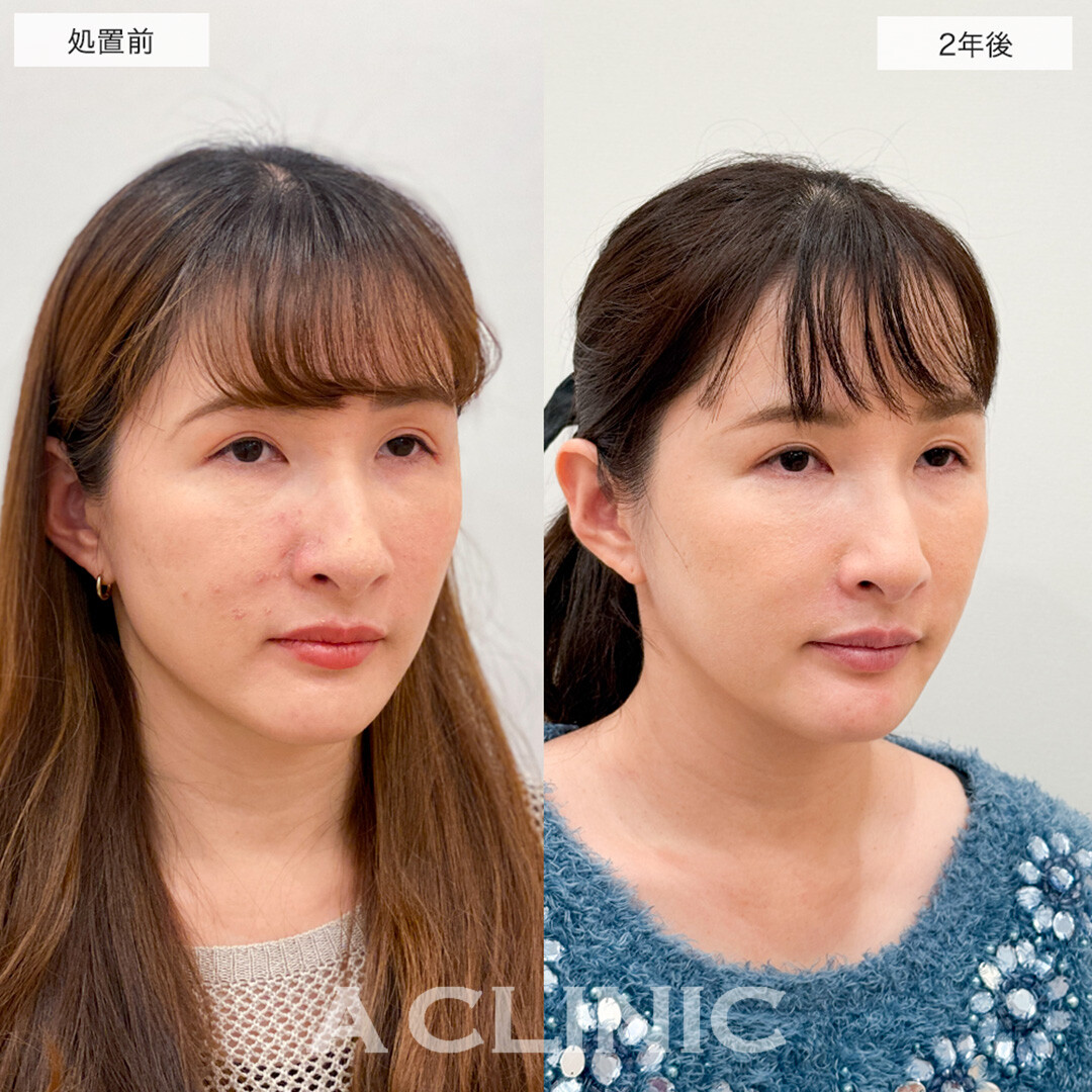【直後の傷跡あり】A式美肌たるみ切開は2年後もたるみを感じない若々しい輪郭のままです!こちら処置前と2年後の症例です(30代女性)