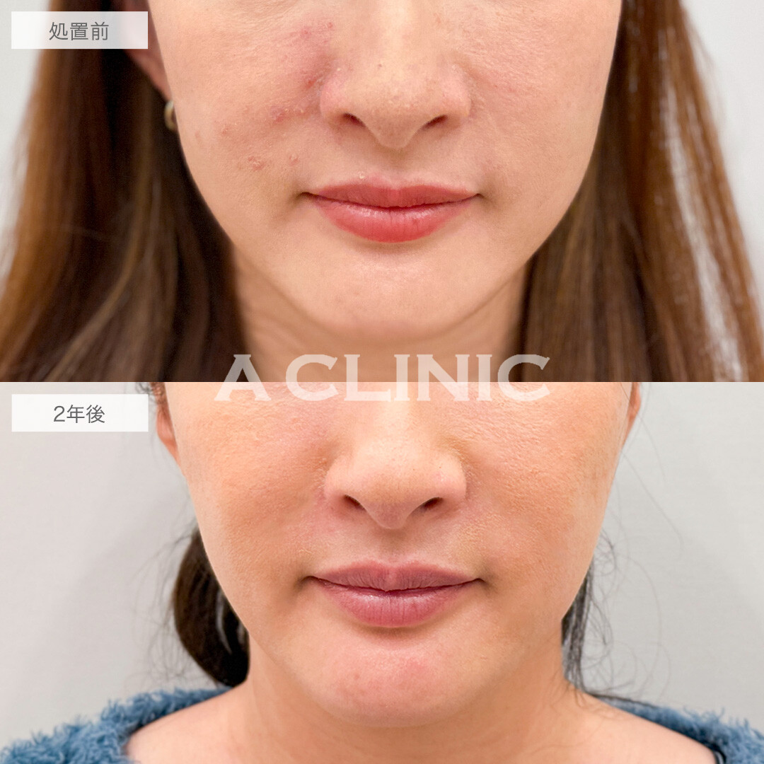 【直後の傷跡あり】A式美肌たるみ切開は2年後もたるみを感じない若々しい輪郭のままです!こちら処置前と2年後の症例です(30代女性)