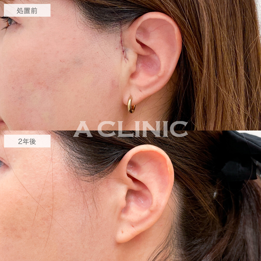 【直後の傷跡あり】A式美肌たるみ切開は2年後もたるみを感じない若々しい輪郭のままです!こちら処置前と2年後の症例です(30代女性)