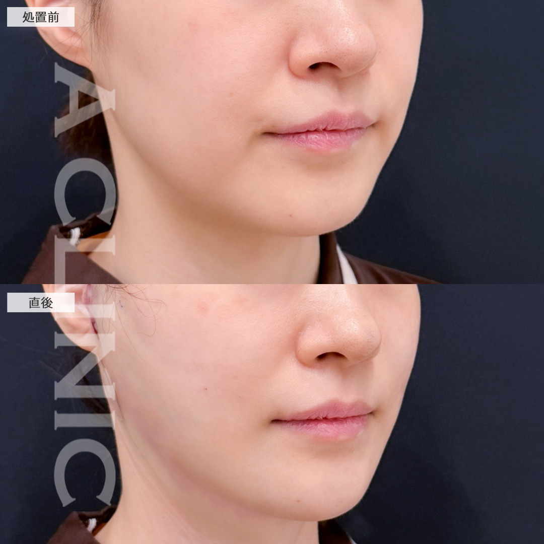 A式美肌たるみ切開と1day小顔脂肪吸引でたるみも脂肪もなくせます！こちら処置前と直後の症例です(40代女性)