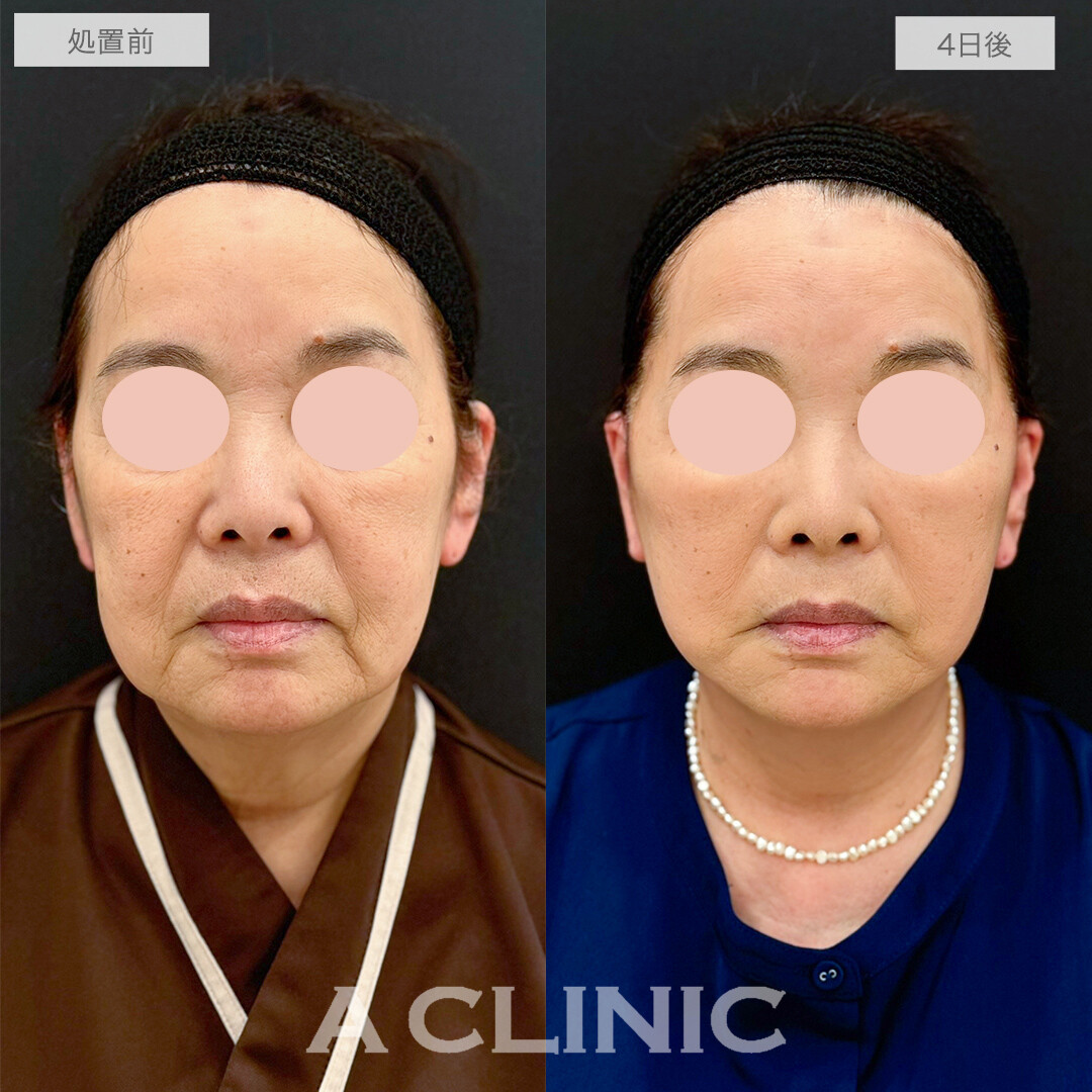 A式美肌たるみ切開で輪郭がギュンっと上がって若返りました！処置前と4日後の症例です(60代女性)