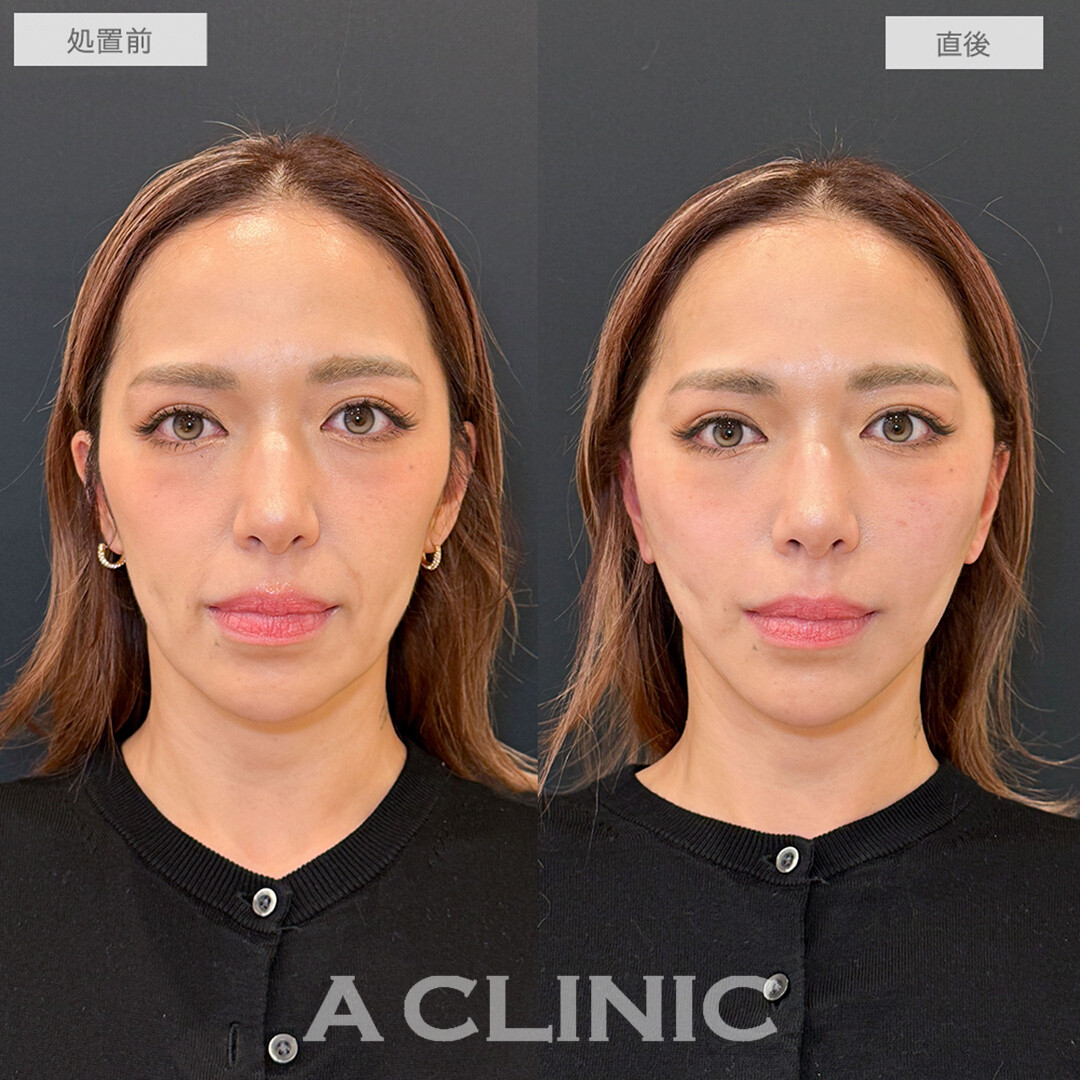 A式美肌たるみ切開で悩みだったほうれい線が消え若返り！こちら処置前と直後の症例です(40代女性)