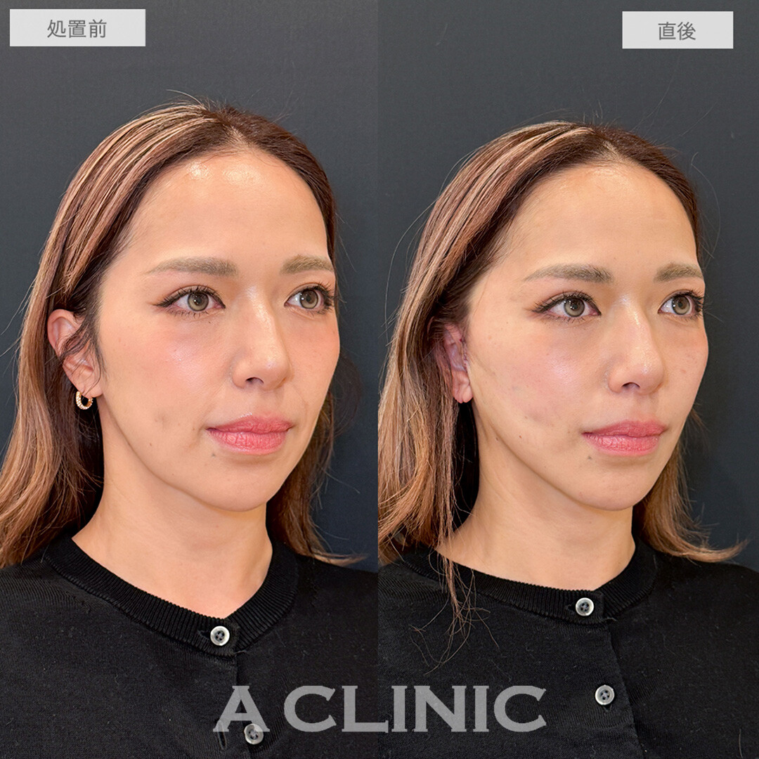 A式美肌たるみ切開で悩みだったほうれい線が消え若返り！こちら処置前と直後の症例です(40代女性)