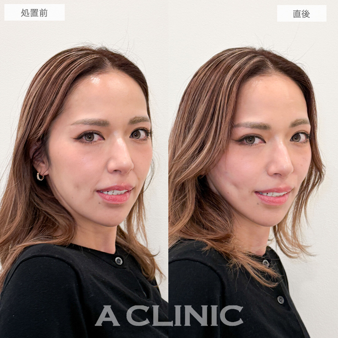 A式美肌たるみ切開で悩みだったほうれい線が消え若返り！こちら処置前と直後の症例です(40代女性)