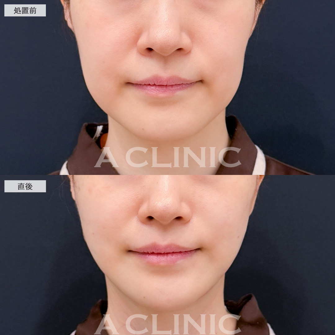 A式美肌たるみ切開と1day小顔脂肪吸引でたるみも脂肪もなくせます！こちら処置前と直後の症例です(40代女性)