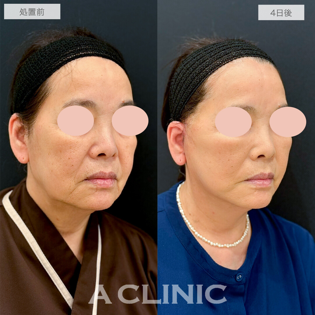 A式美肌たるみ切開で輪郭がギュンっと上がって若返りました！処置前と4日後の症例です(60代女性)