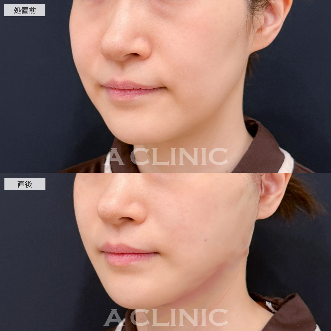 A式美肌たるみ切開と1day小顔脂肪吸引でたるみも脂肪もなくせます！こちら処置前と直後の症例です(40代女性)