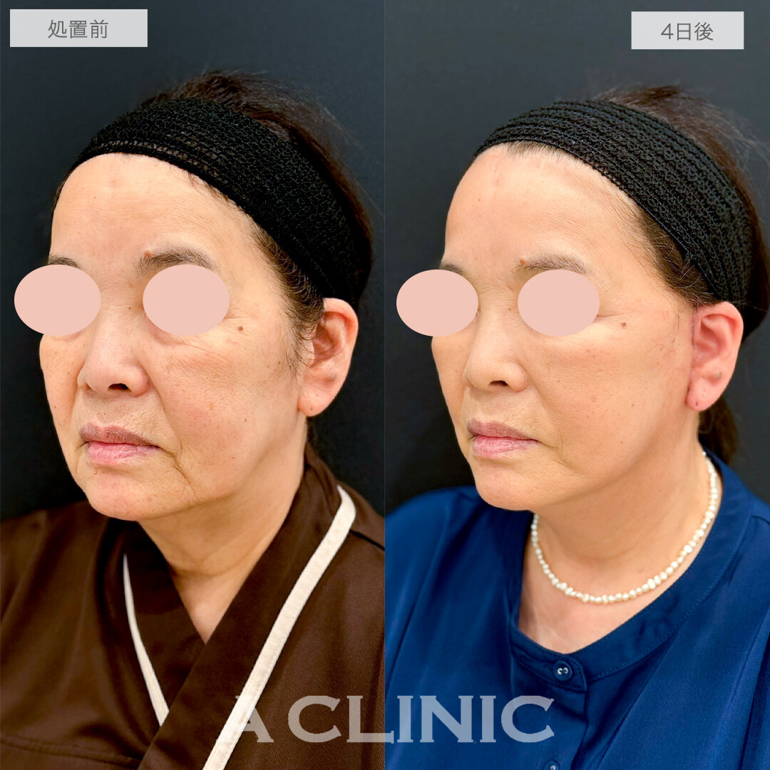 A式美肌たるみ切開で輪郭がギュンっと上がって若返りました！処置前と4日後の症例です(60代女性)