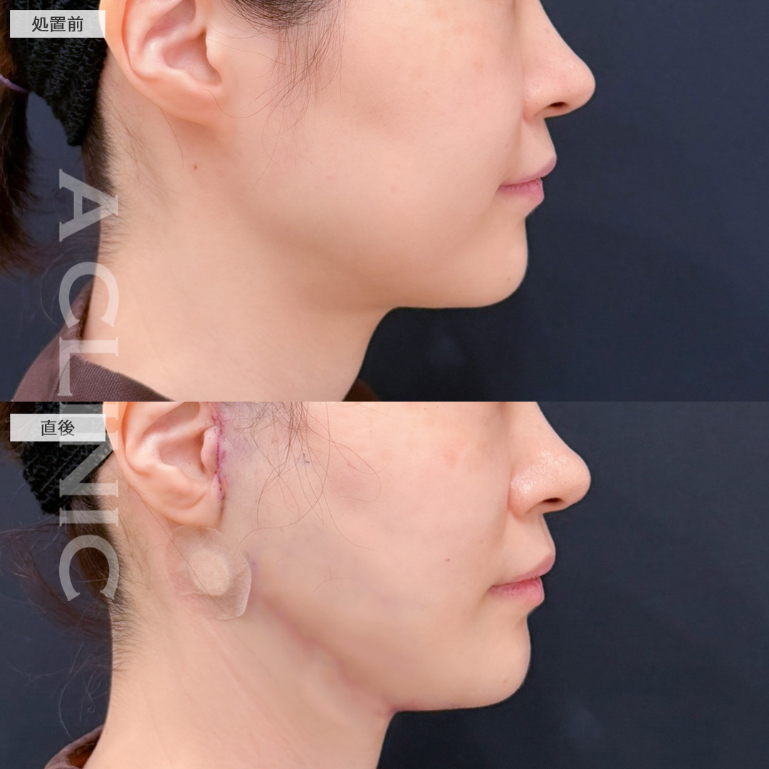 A式美肌たるみ切開と1day小顔脂肪吸引でたるみも脂肪もなくせます！こちら処置前と直後の症例です(40代女性)