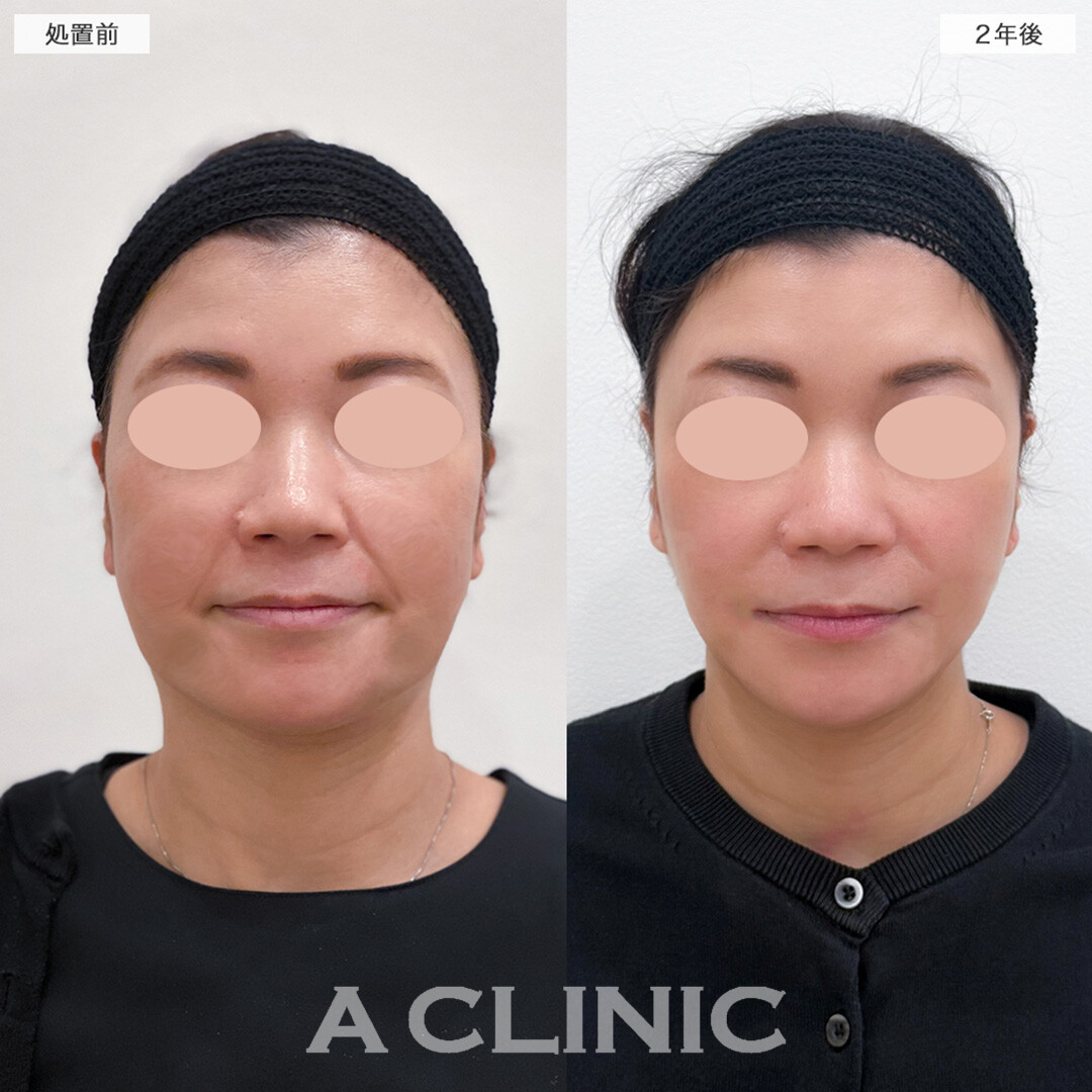 【直後の傷跡あり】A式美肌たるみ切開でたるみを引き上げ美しい年齢の重ね方へ！処置前と2年後の症例です(40代女性)