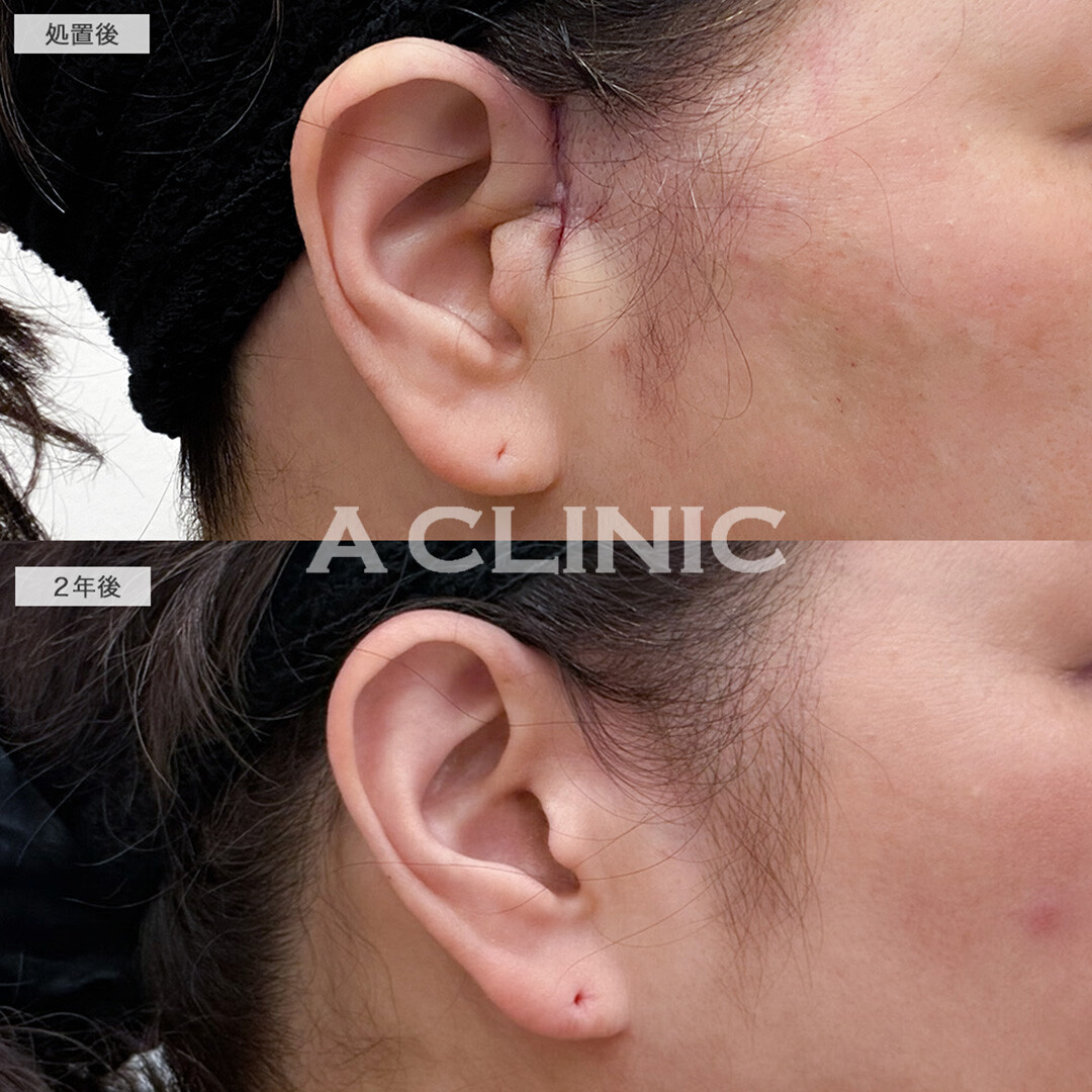 【直後の傷跡あり】A式美肌たるみ切開でたるみを引き上げ美しい年齢の重ね方へ！処置前と2年後の症例です(40代女性)