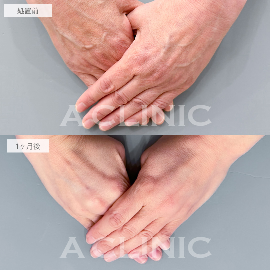 手の甲のヒアルロン酸注入とPRP血小板療法で年齢の出やすい手も若返り！こちら処置前と1ヶ月後の症例です(50代女性)