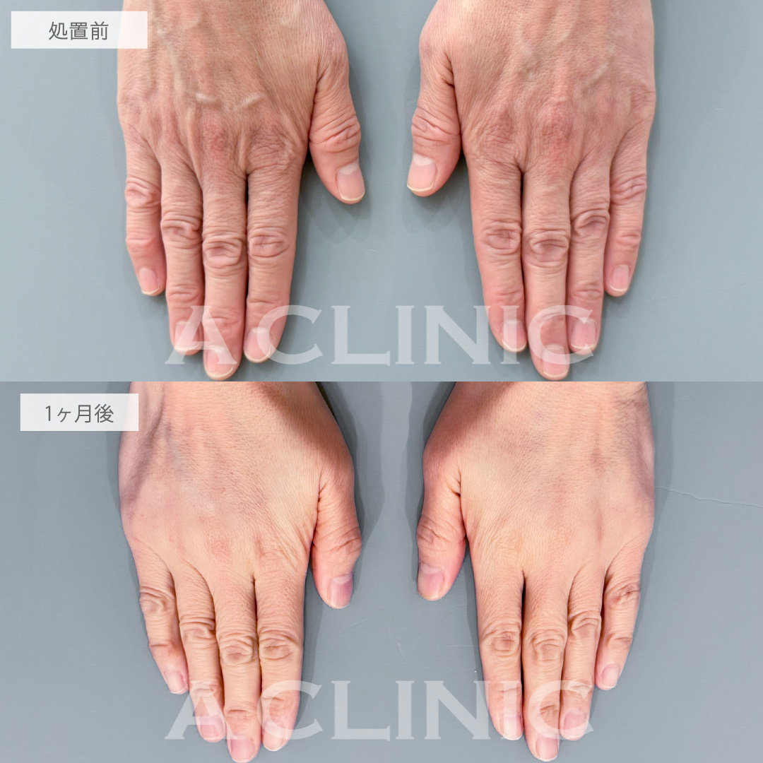 手の甲のヒアルロン酸注入とPRP血小板療法で年齢の出やすい手も若返り！こちら処置前と1ヶ月後の症例です(50代女性)