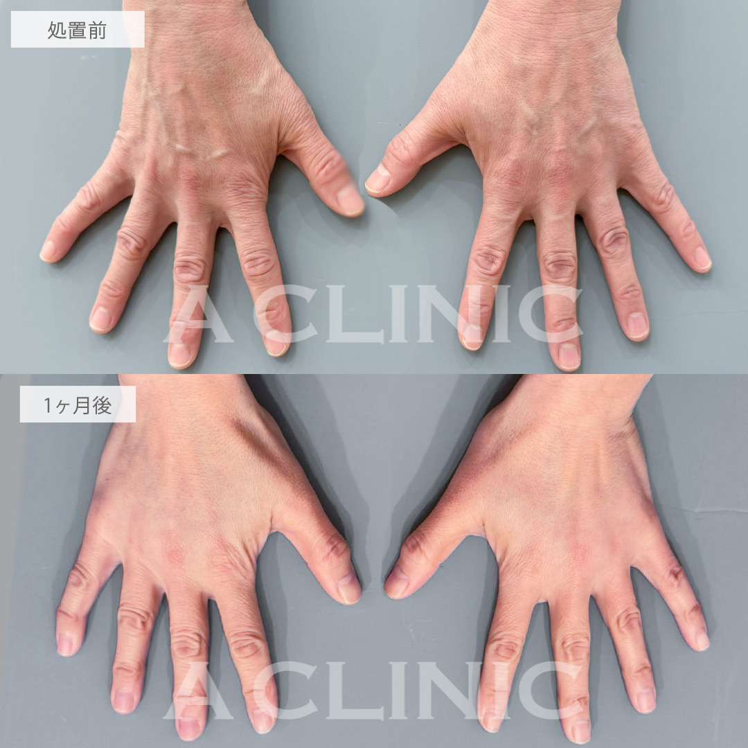 手の甲のヒアルロン酸注入とPRP血小板療法で年齢の出やすい手も若返り！こちら処置前と1ヶ月後の症例です(50代女性)