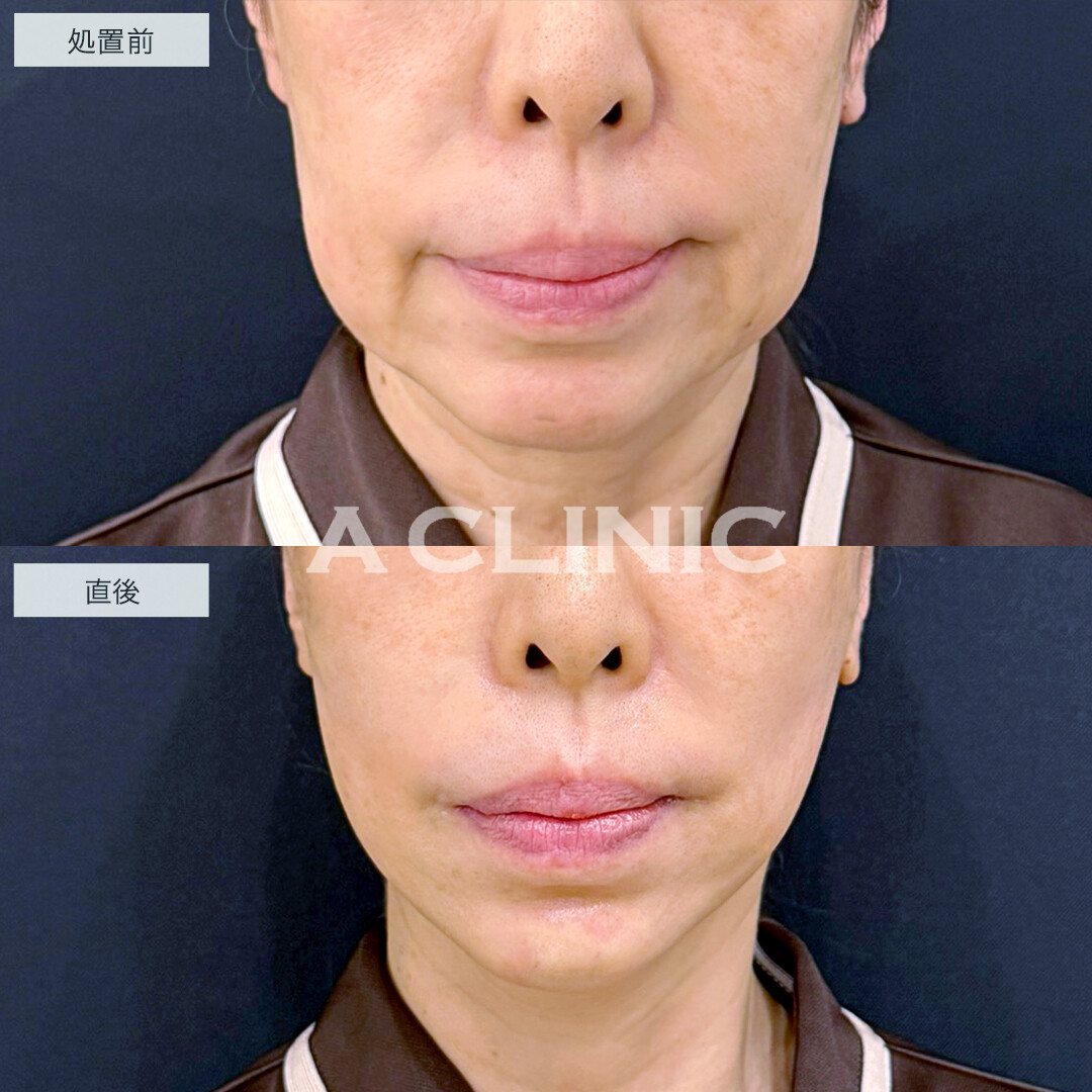 XERF(ザーフ)とあごのヒアルロン酸注入で輪郭をスッキリ改善！処置前と直後の症例です(60代女性)