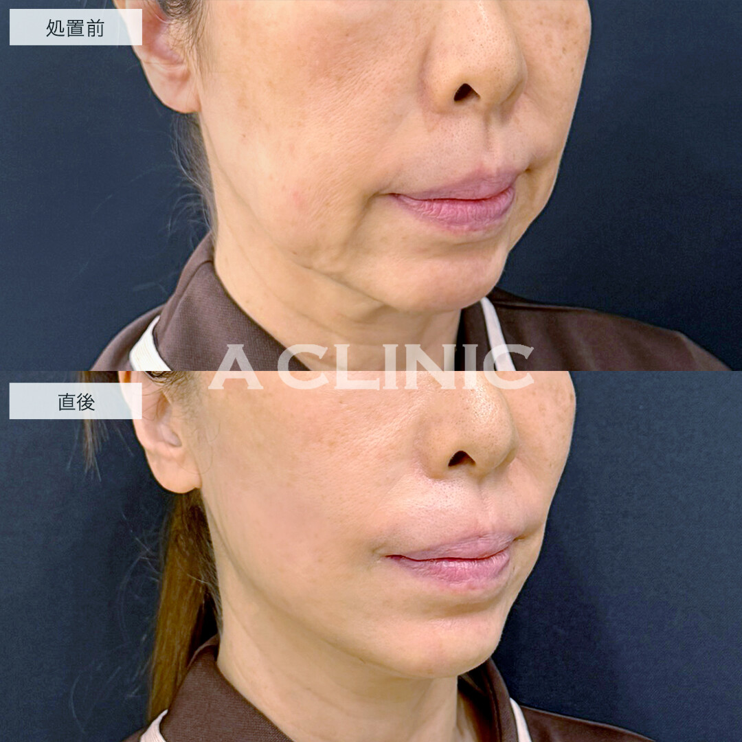 XERF(ザーフ)とあごのヒアルロン酸注入で輪郭をスッキリ改善！処置前と直後の症例です(60代女性)