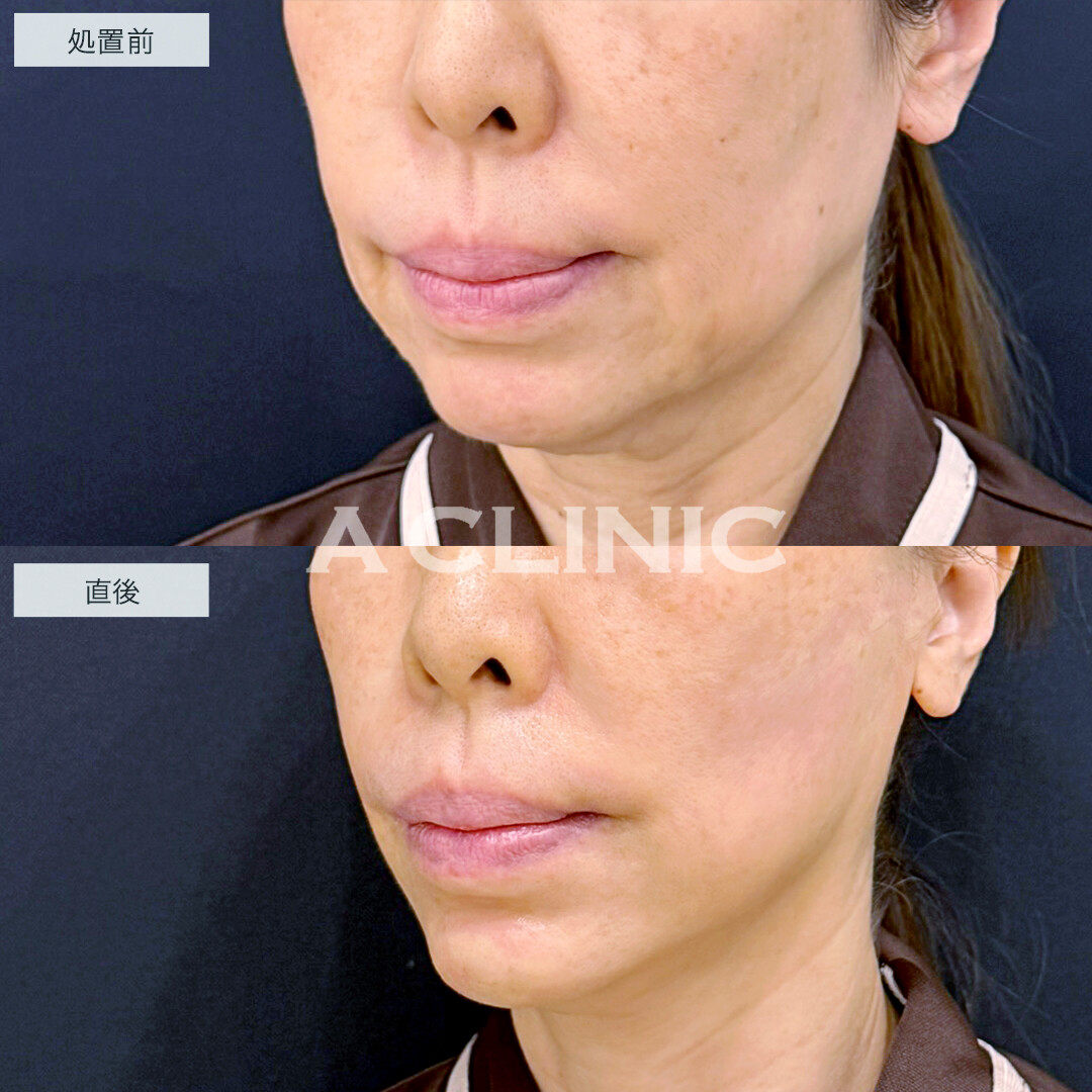 XERF(ザーフ)とあごのヒアルロン酸注入で輪郭をスッキリ改善！処置前と直後の症例です(60代女性)