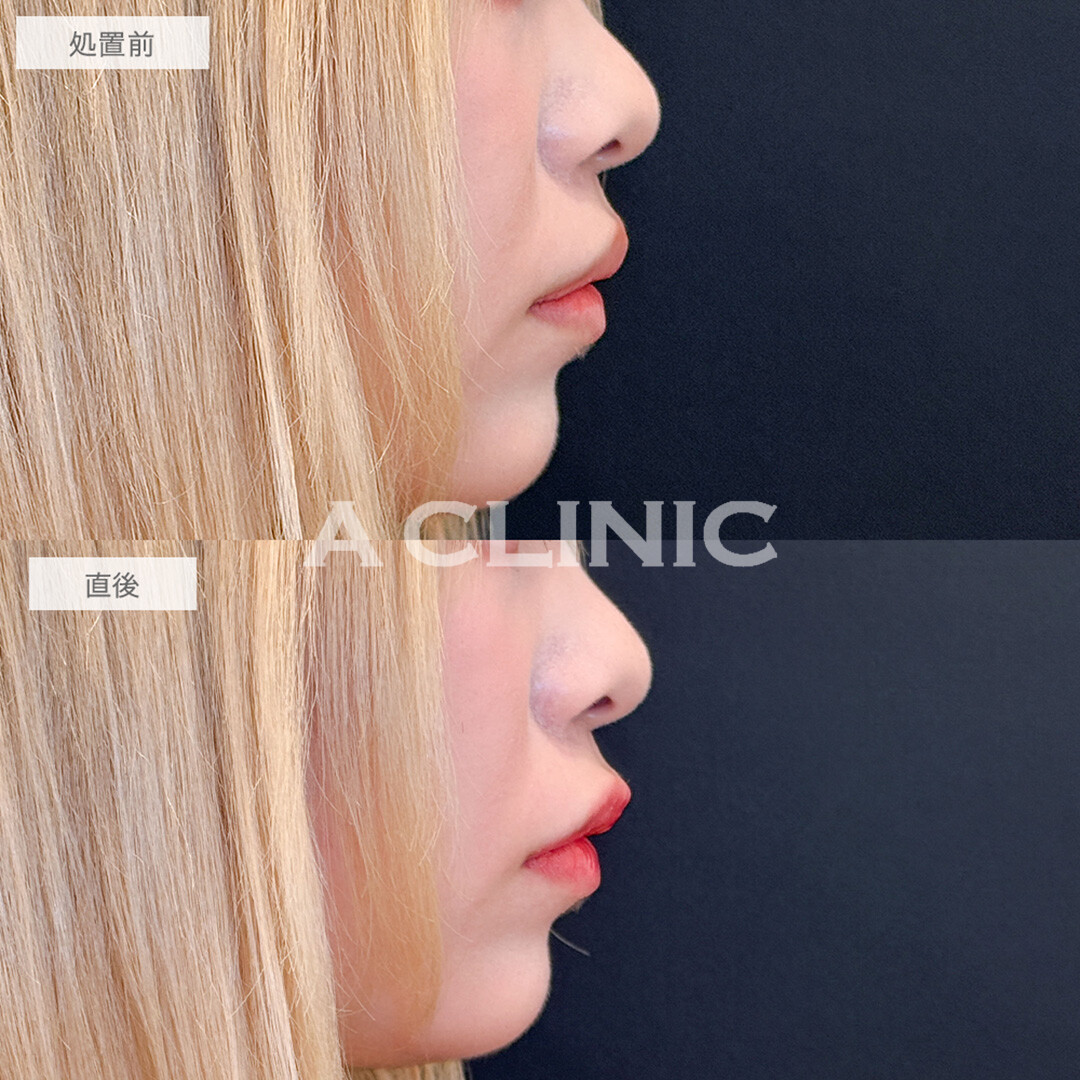 スマイルリップで加工後のような唇が手に入りました！処置前と直後の症例です(10代女性)