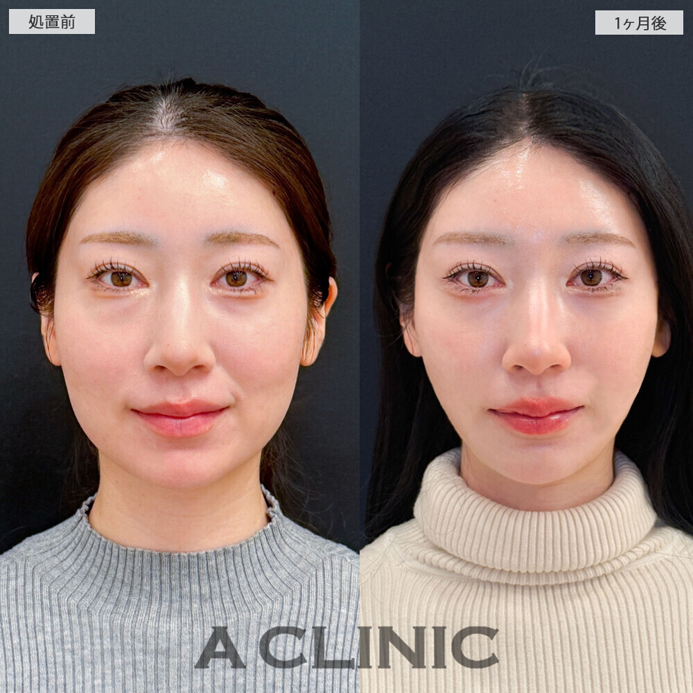 1day小顔脂肪吸引で丸顔が改善されることで大人っぽい雰囲気に！こちら処置前から1ヶ月後の症例です(20代女性)
