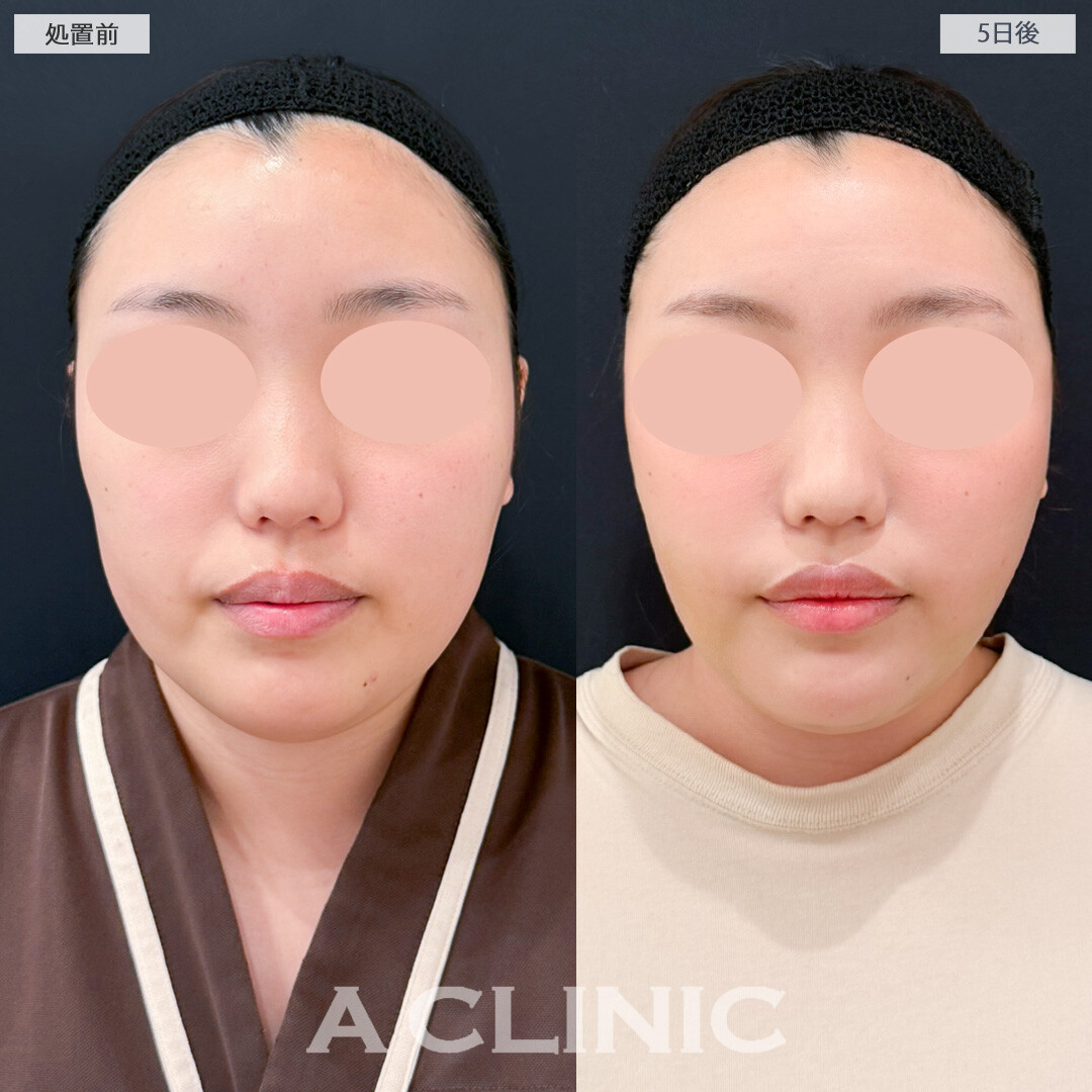 1day小顔脂肪吸引とバッカルファット除去術で術後もそこまで腫れが気にならずに過ごせました！処置前と5日後の症例です(20代女性)