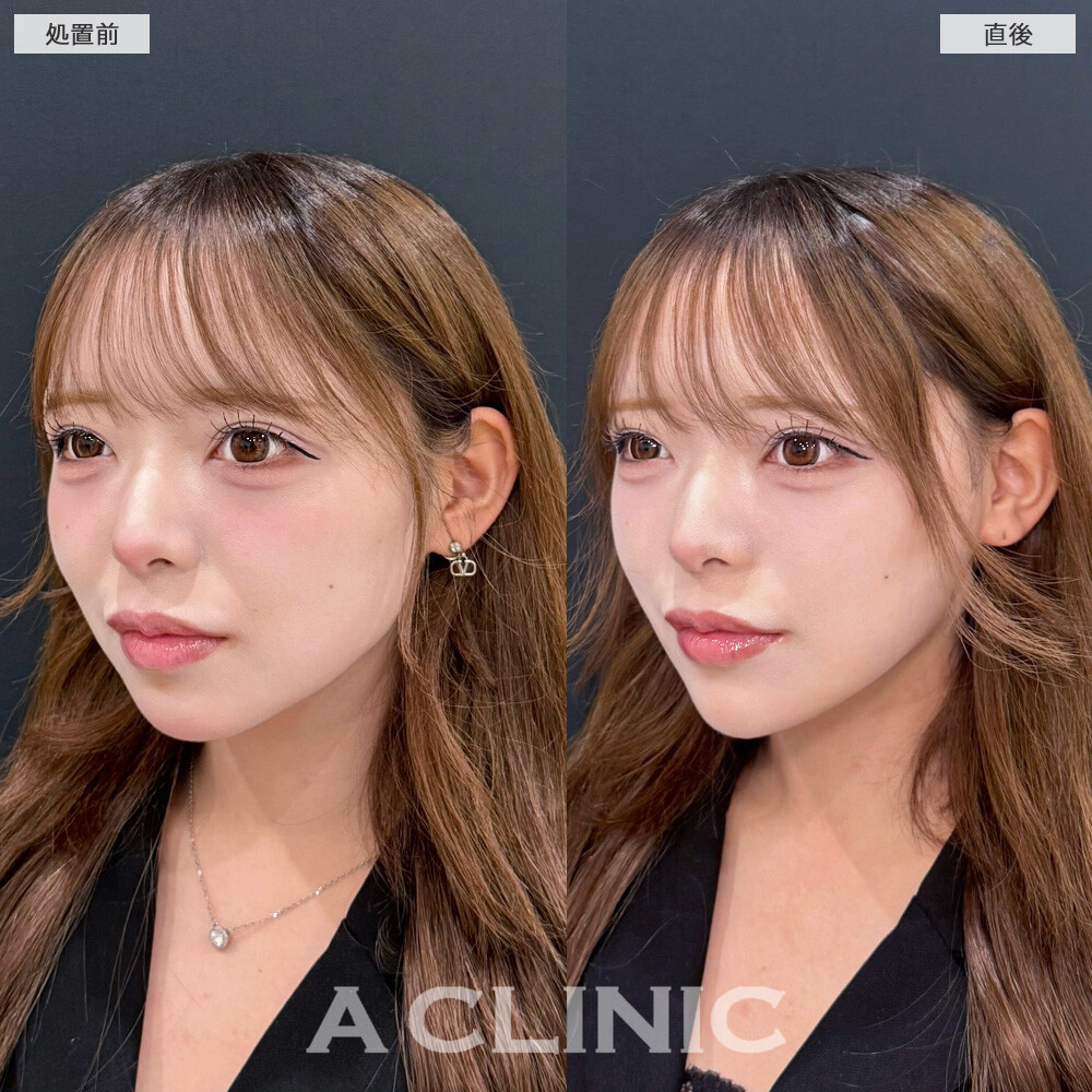 1day小顔脂肪吸引なら直後から腫れるどころか即効小顔になって念願のVフェイスに！こちら処置前と直後の症例です(10代女性)
