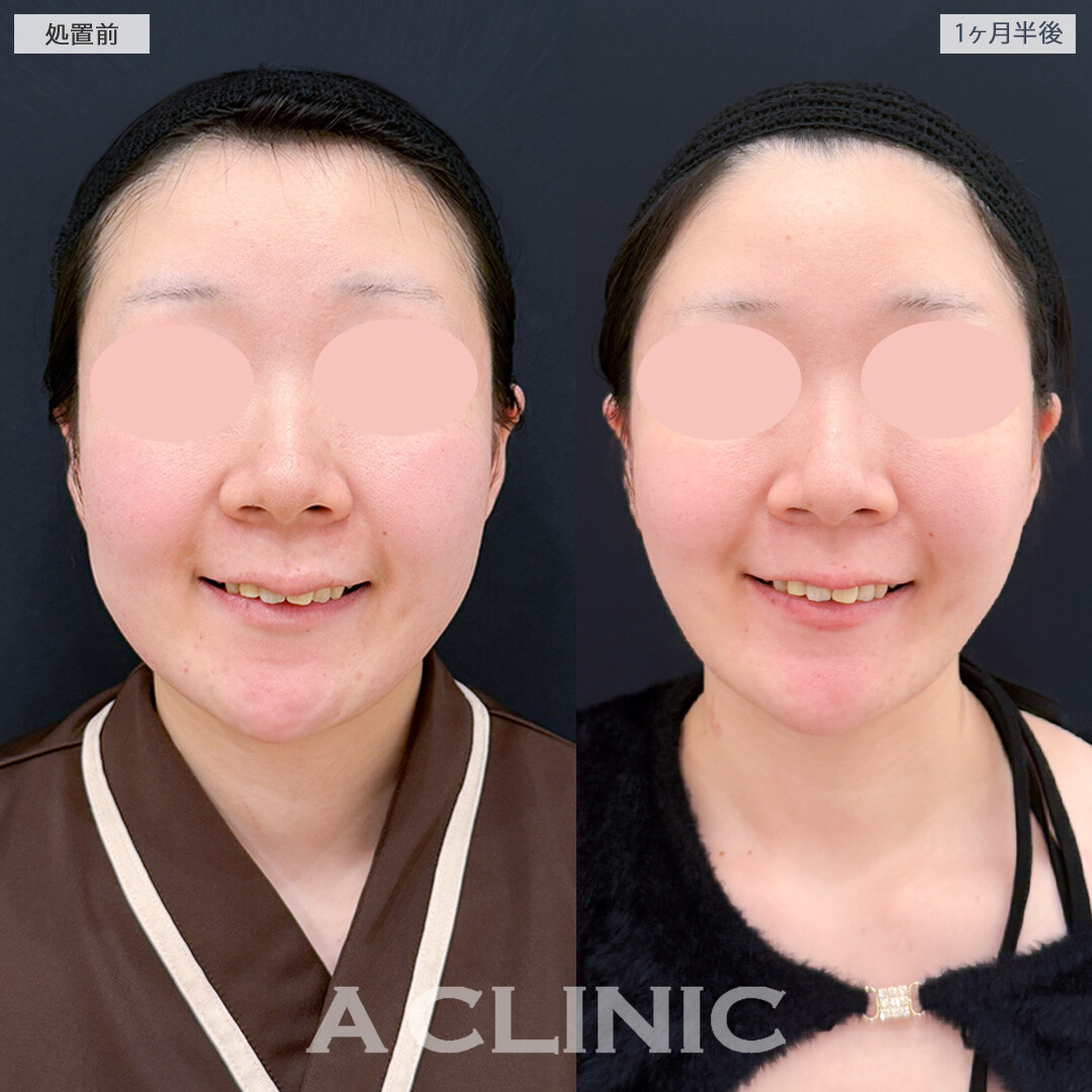 1day小顔脂肪吸引とバッカルファット除去術とあごへのヒアルロン酸注入でダイエットよりもスッキリ感が得られました！処置前と1ヶ月半後の症例です(20代女性)