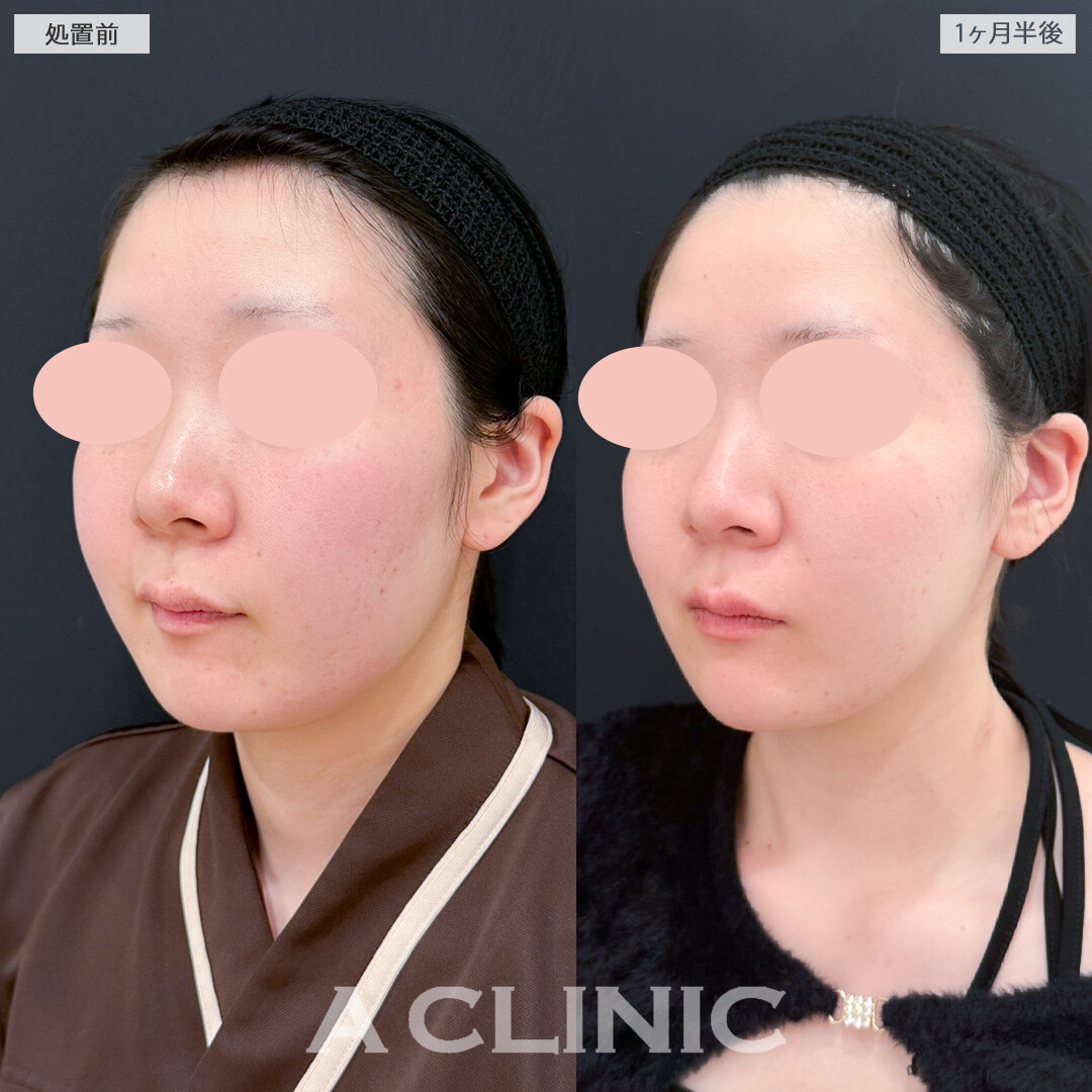 1day小顔脂肪吸引とバッカルファット除去術とあごへのヒアルロン酸注入でダイエットよりもスッキリ感が得られました！処置前と1ヶ月半後の症例です(20代女性)