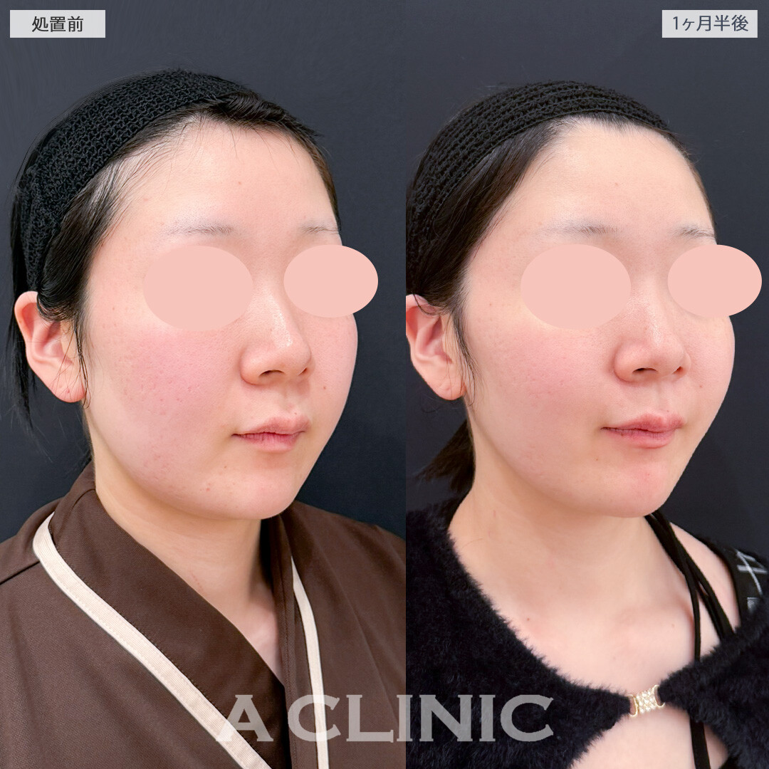 1day小顔脂肪吸引とバッカルファット除去術とあごへのヒアルロン酸注入でダイエットよりもスッキリ感が得られました！処置前と1ヶ月半後の症例です(20代女性)