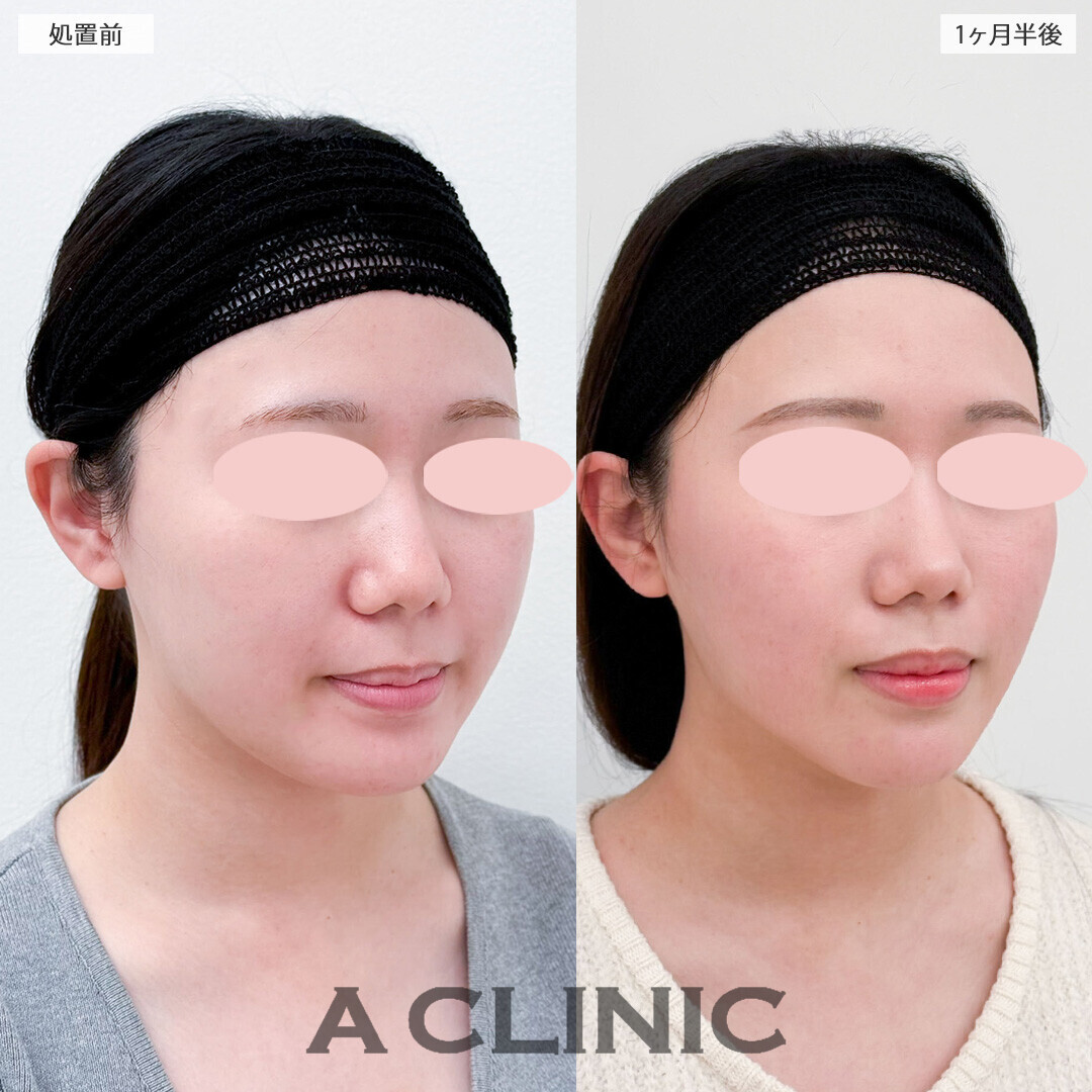 バッカルファット除去術で頬の膨らみが減りました！こちら処置前と1ヶ月半後の症例です(20代女性)