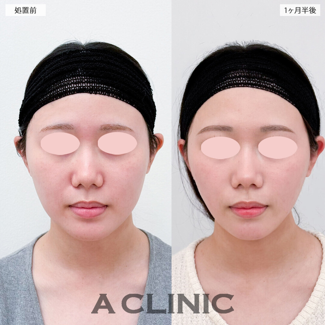 バッカルファット除去術で頬の膨らみが減りました！こちら処置前と1ヶ月半後の症例です(20代女性)