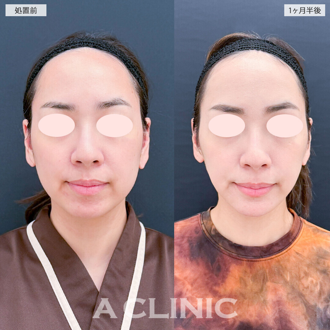 1day小顔脂肪吸引と小顔エラボトックスとあごへのヒアルロン酸注入でバランスの良い小顔に！こちら処置前と1ヶ月半後の症例です(30代女性)