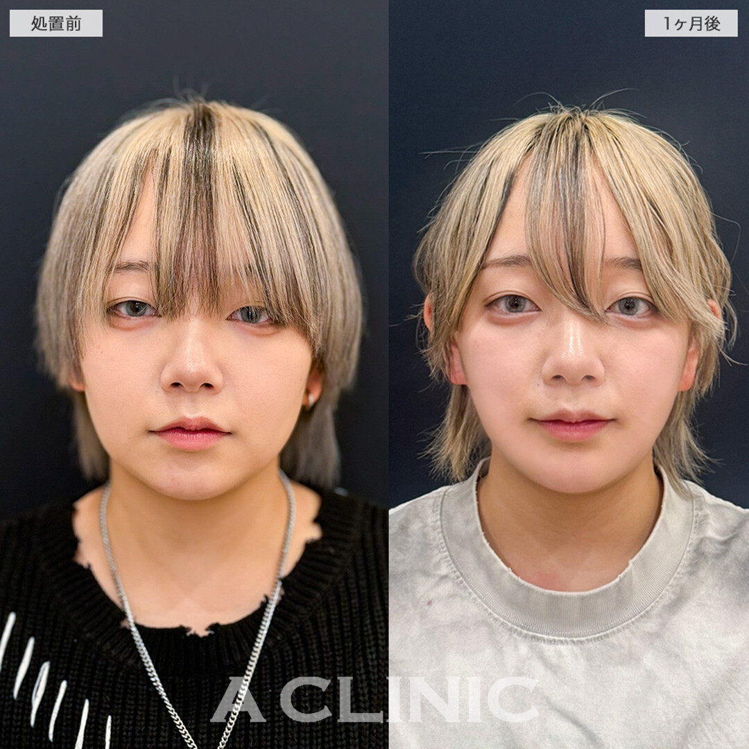 1day小顔脂肪吸引とあごへのヒアルロン酸注入で口横のもたつきやたるみをスッキリ整える！こちら処置前と1ヶ月後の症例です(20代女性)