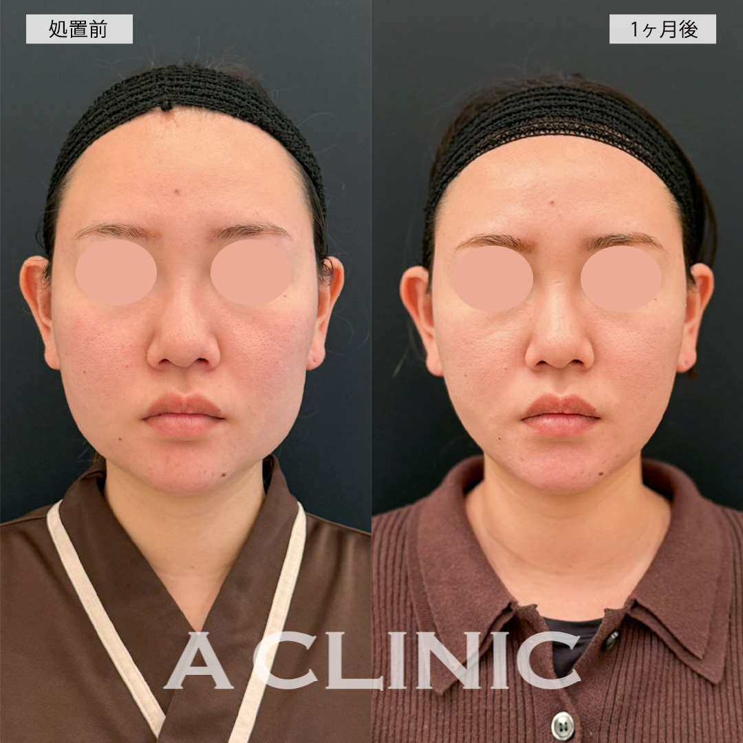 1day小顔脂肪吸引でお顔が一回り程小さくなりました！こちら処置前と1ヶ月後の症例です(20代女性)