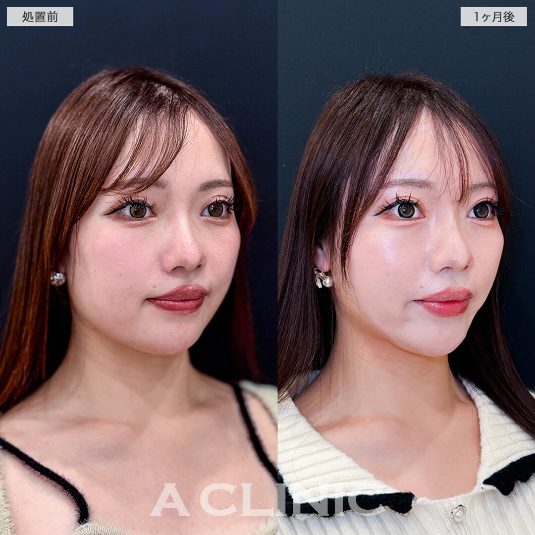 1day小顔脂肪吸引と小顔エラボトックスでさりげなく洗練された印象へ！こちら処置前と1ヶ月後の症例です(20代女性)
