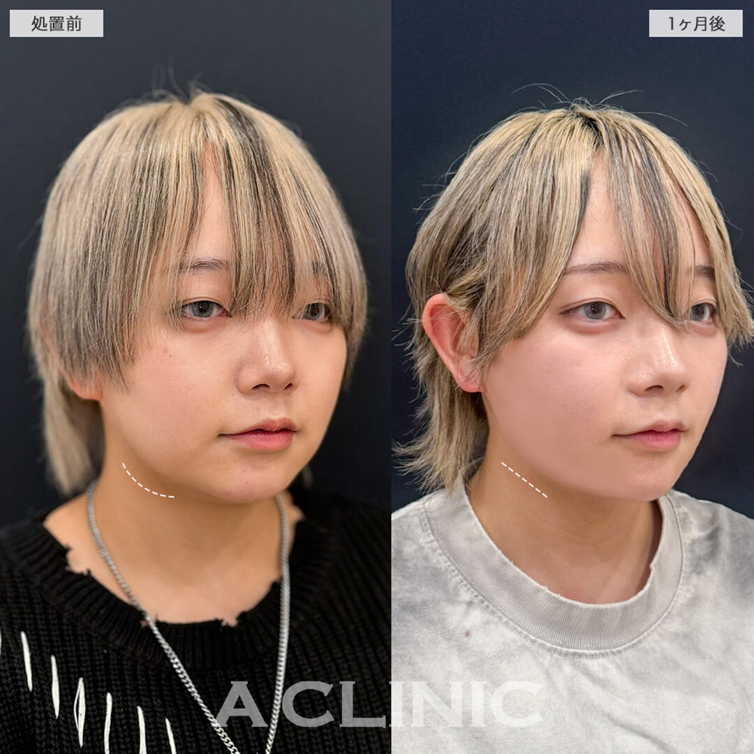 1day小顔脂肪吸引とあごへのヒアルロン酸注入で口横のもたつきやたるみをスッキリ整える！こちら処置前と1ヶ月後の症例です(20代女性)