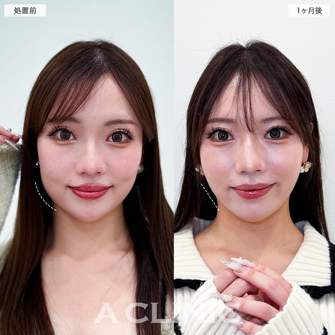 1day小顔脂肪吸引と小顔エラボトックスでさりげなく洗練された印象へ！こちら処置前と1ヶ月後の症例です(20代女性)