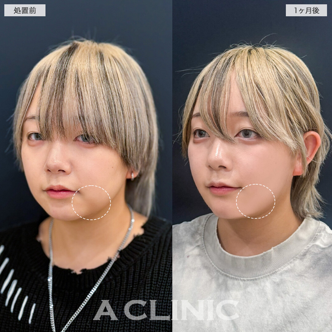 1day小顔脂肪吸引とあごへのヒアルロン酸注入で口横のもたつきやたるみをスッキリ整える！こちら処置前と1ヶ月後の症例です(20代女性)