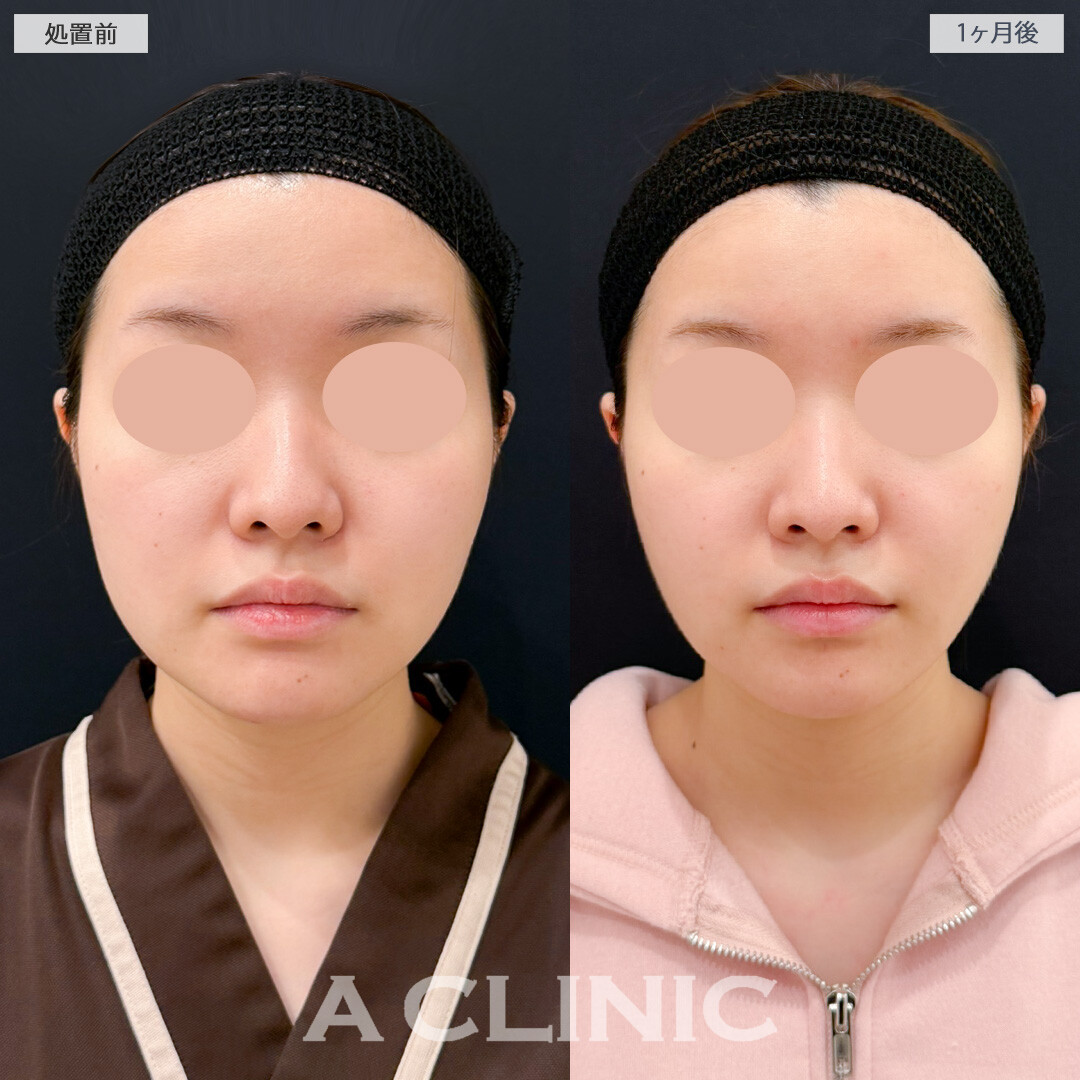 1day小顔脂肪吸引とバッカルファット除去術でここからさらにスッキリ変化していきます！処置前と1ヶ月後の症例です(20代女性)