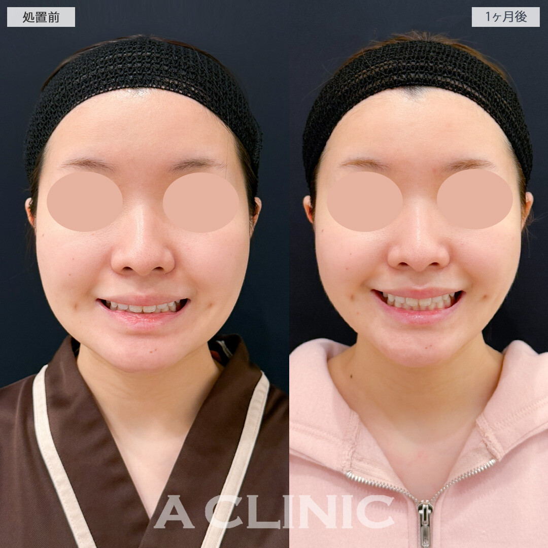 1day小顔脂肪吸引とバッカルファット除去術でここからさらにスッキリ変化していきます！処置前と1ヶ月後の症例です(20代女性)