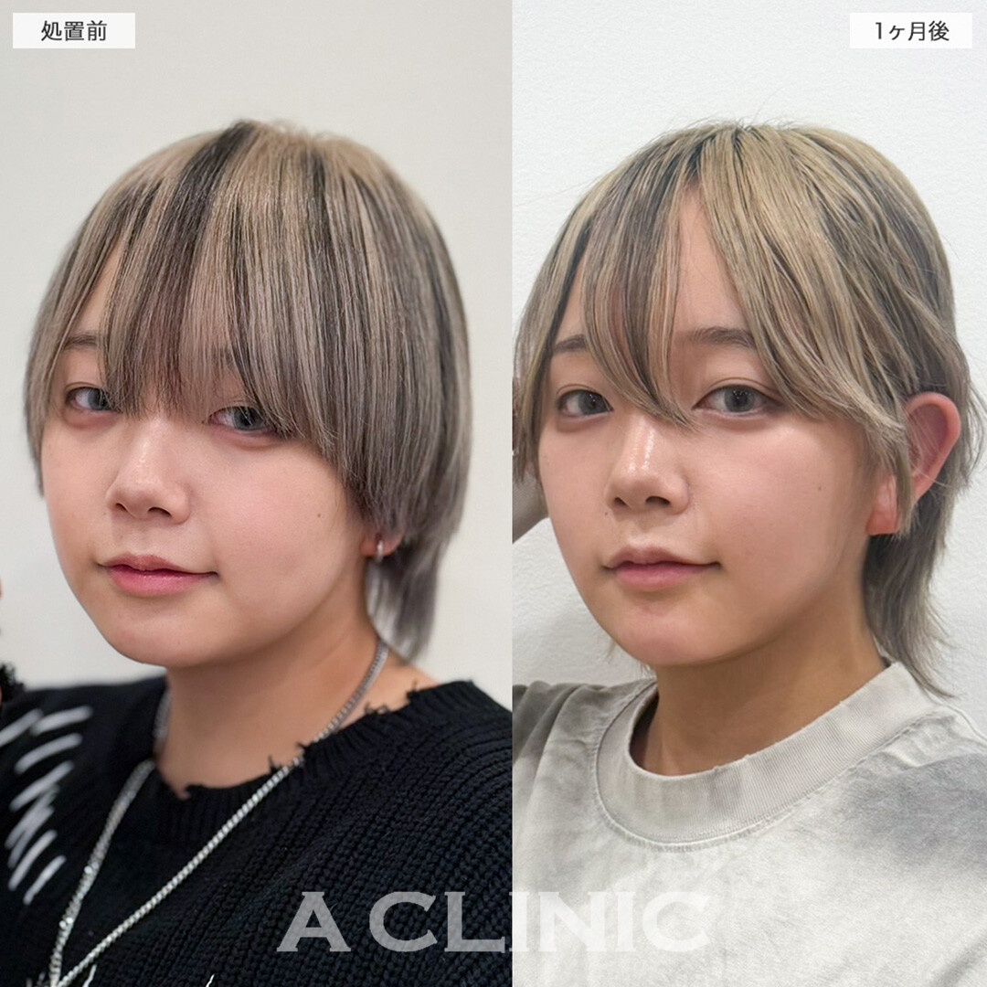 1day小顔脂肪吸引とあごへのヒアルロン酸注入で口横のもたつきやたるみをスッキリ整える！こちら処置前と1ヶ月後の症例です(20代女性)