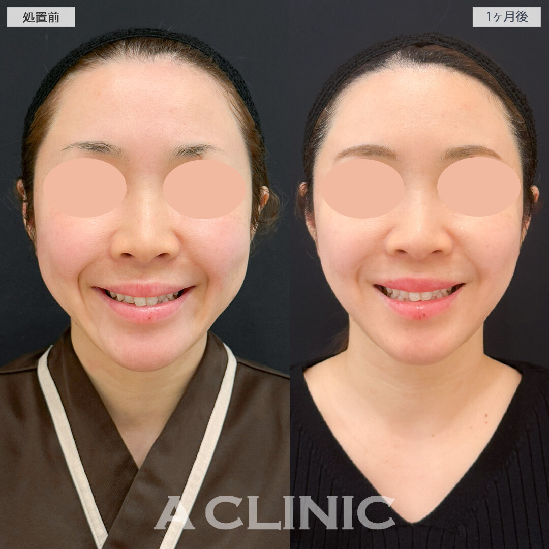1day小顔脂肪吸引とナゾラビアルファット除去術とバッカルファット除去術でお顔の肉付きを減らせました！処置前と1ヶ月後の症例です(30代女性)